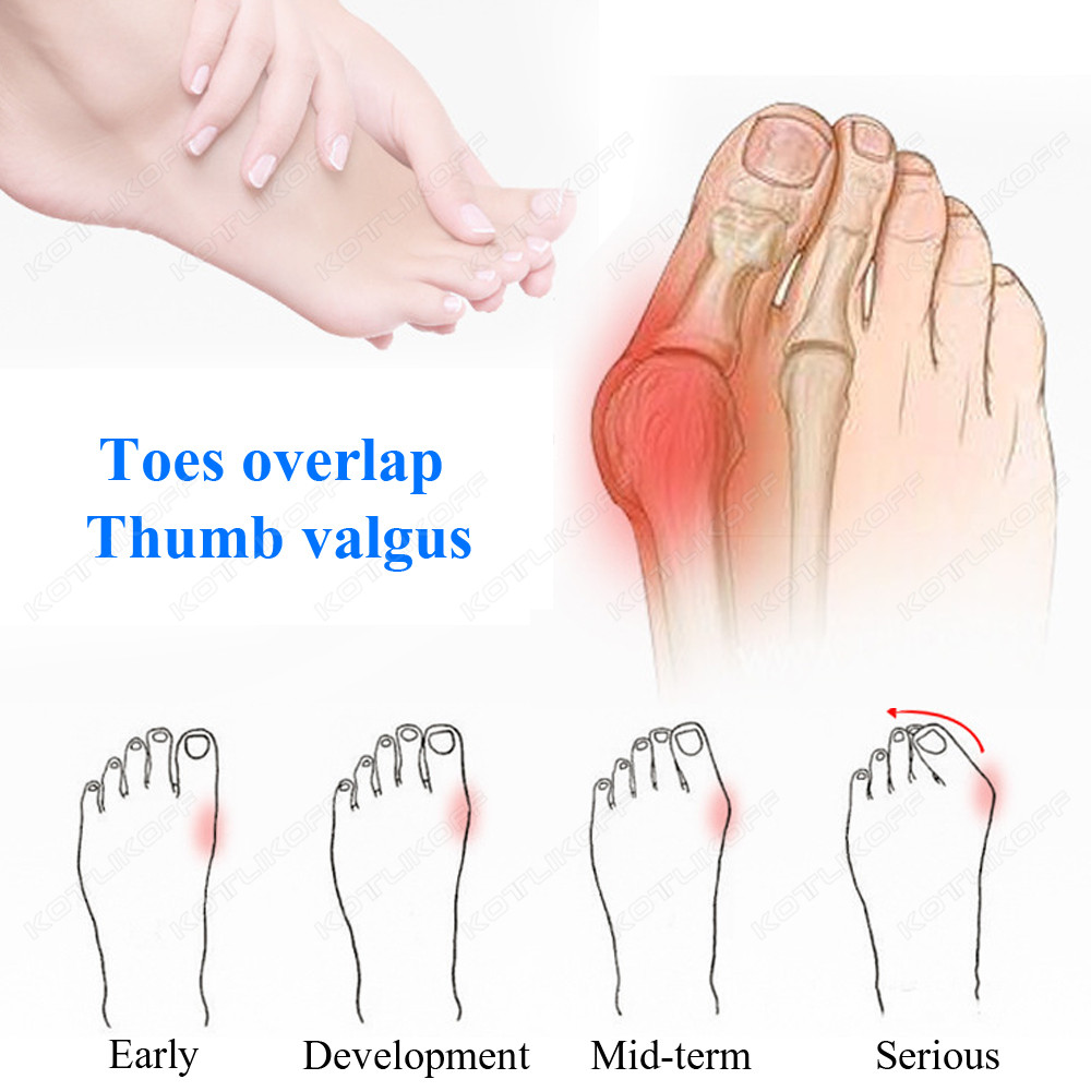 Toe Protective Toes Separator  - Toe Separator Silicon 评论和价格